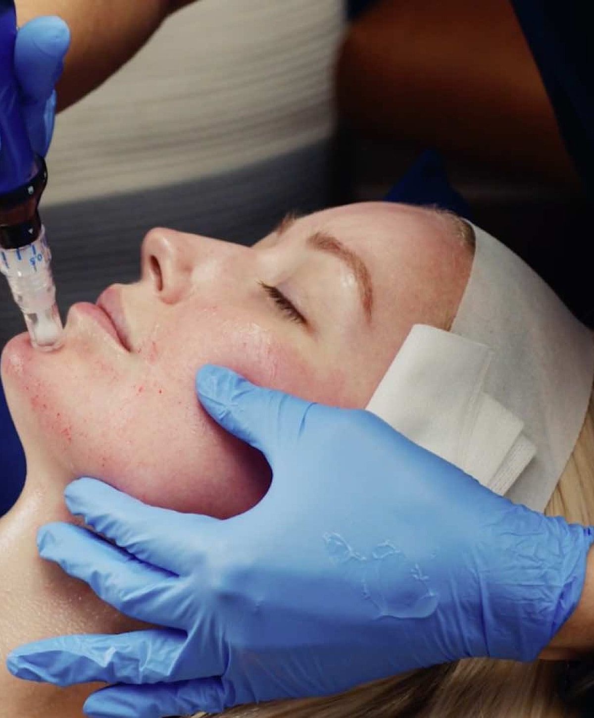 Laser treatment session in a skincare clinic.