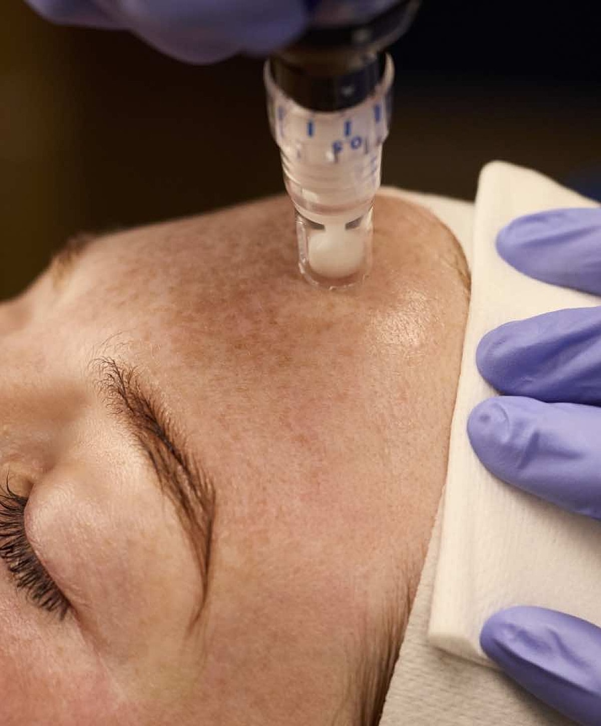 Microneedling treatment on a client's forehead.